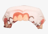 従来の義歯の写真